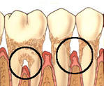 Perfect Smile periodontium with advanced periodontitis